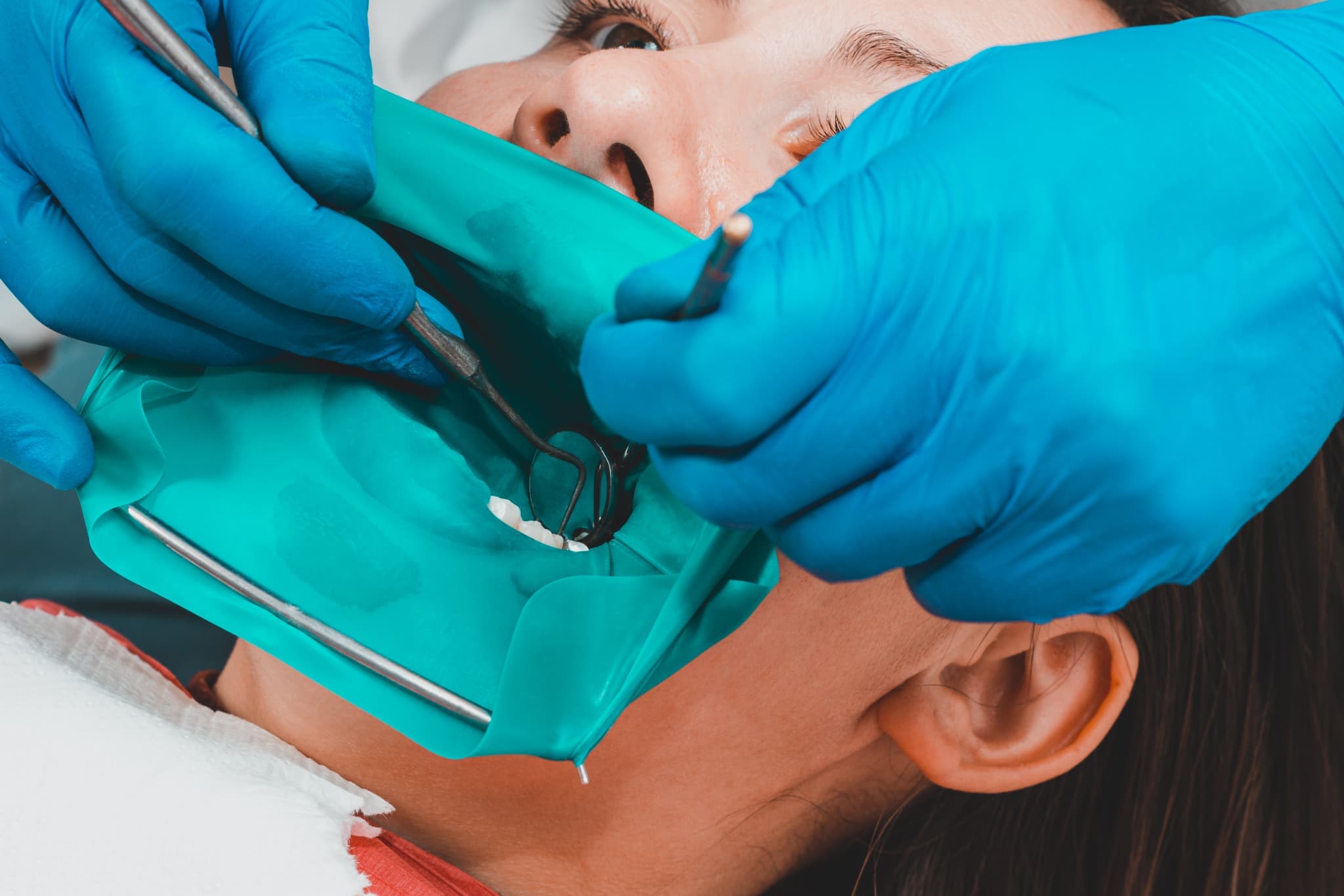 ラバーダムの使用